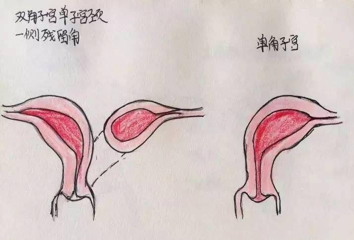 单角子宫是什么意思