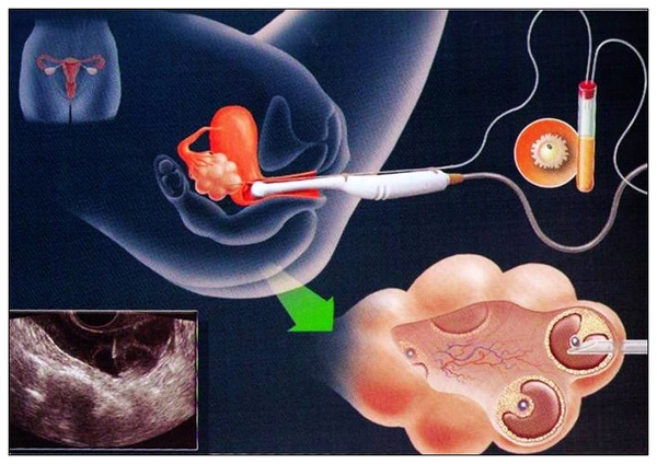经阴道取卵较为常见