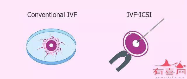 单精子注射好还是常规体外受精好