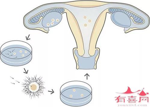 体外受精