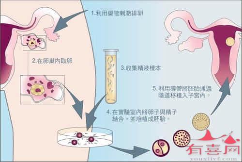 广东试管婴儿流程