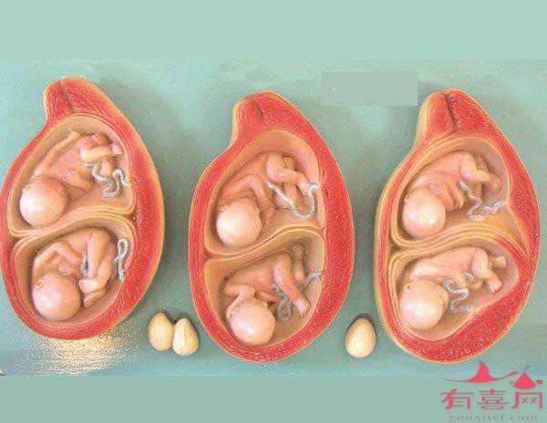 多胎妊娠是好是坏？做到这些很重要