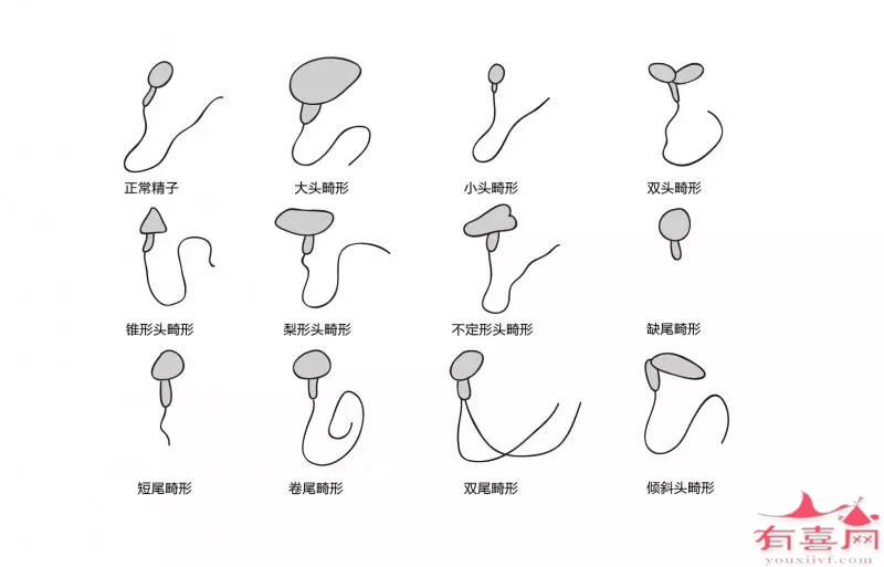 精子畸形率8%正常吗