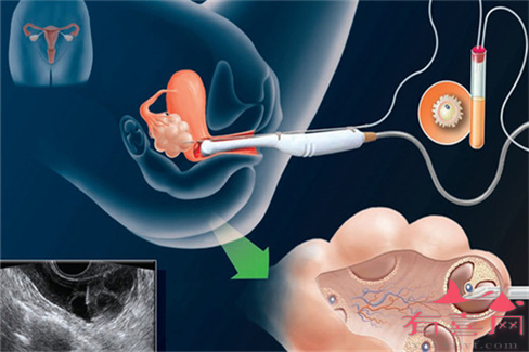 试管婴儿能不能降低宫外孕几率