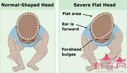 小头症的宝宝会怎么样，有什么症状
