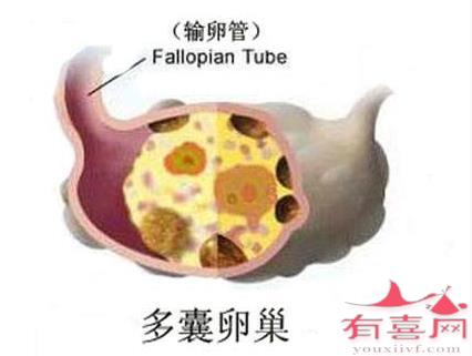 多囊促排在月经第几天开始