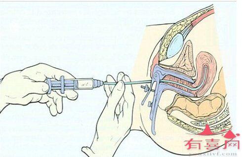 女方做人工受孕痛吗