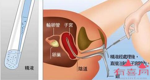 不孕女性做人工受孕痛吗