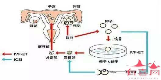 第二代试管婴儿怎么做的全过程