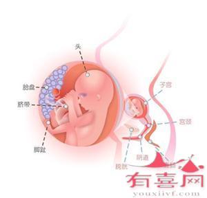 怀孕一个月可以吃药流产吗