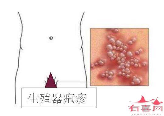 单纯疱疹病毒2型(HSV-11)IgM抗体是什么意思