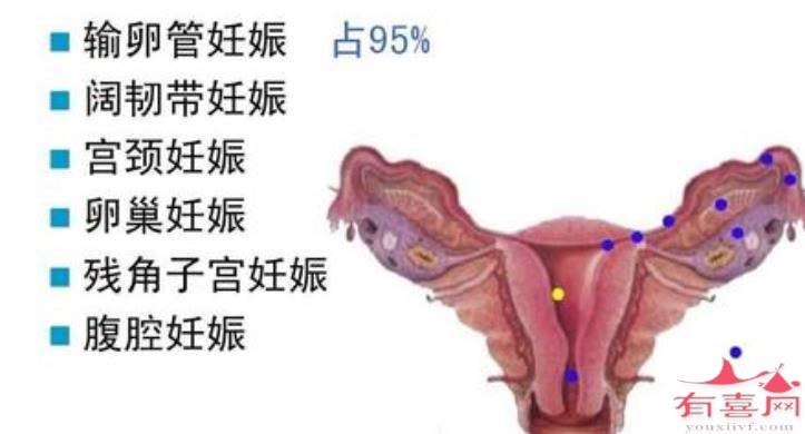 宫颈妊娠会出血吗