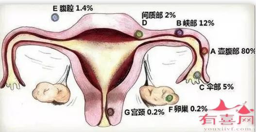 宫颈妊娠早期多久会有出血