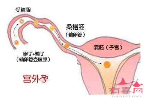 宫颈妊娠能回到宫腔吗