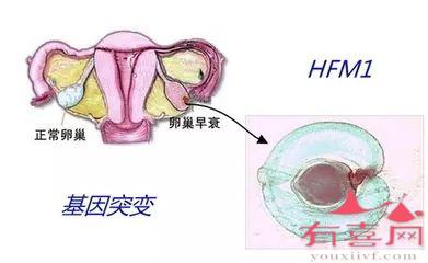 卵巢早衰的原因是什么