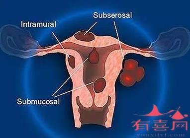 子宫肌瘤挂什么科