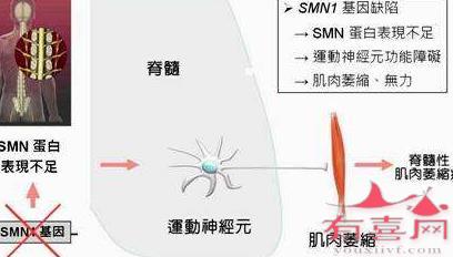 脊肌萎缩症的引起原因