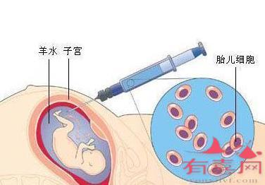 脊肌萎缩症的产前筛查有哪些