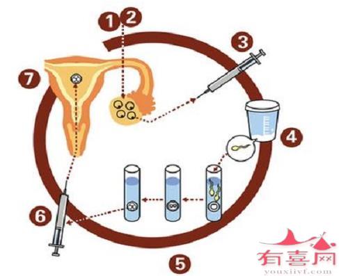 取卵能打麻药吗