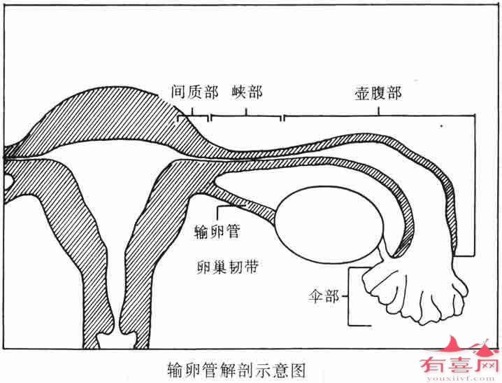 输卵管积水粘连不通畅怎么治疗