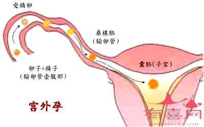 输卵管歪曲有粘连怎么治疗