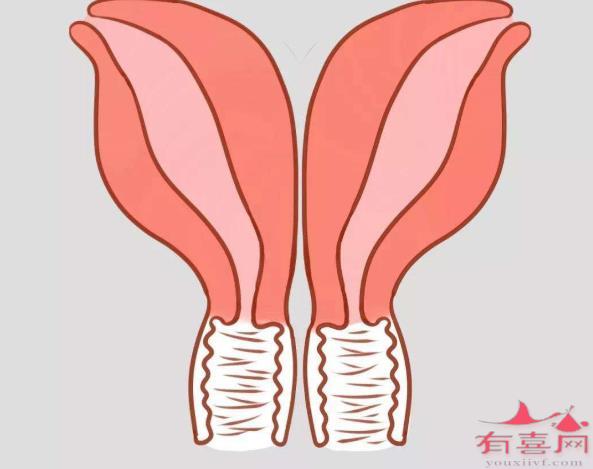 双子宫必须切除一个吗