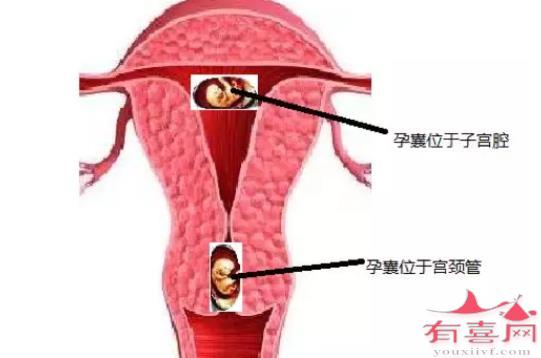 宫颈妊娠的鉴别诊断