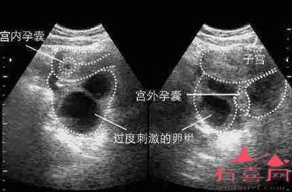 宫颈妊娠属于宫外孕吗