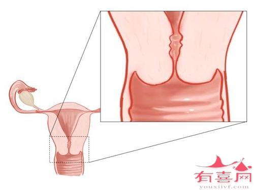 宫颈分泌腺闭锁怀孕几率大吗