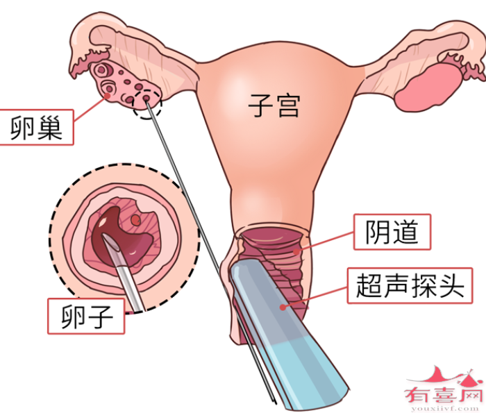 取卵的危害是什么