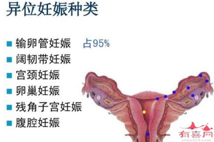 引起宫颈管妊娠的原因是什么