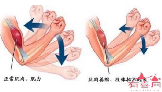 脊肌萎缩症如何治疗