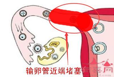 治疗输卵管堵塞的方法有几种