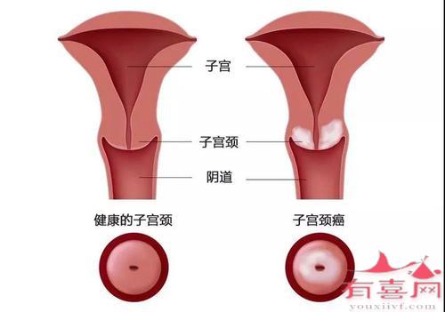 宫颈腺囊肿可以自愈吗