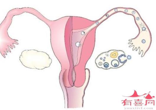 单侧输卵管堵塞的治疗方法是什么