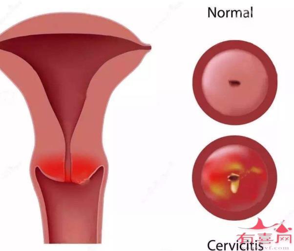 慢性宫颈炎伴鳞化是什么意思