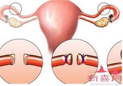 没输卵管能做试管婴儿吗