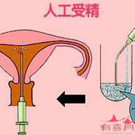 想知道人工授精成功率有多大吗