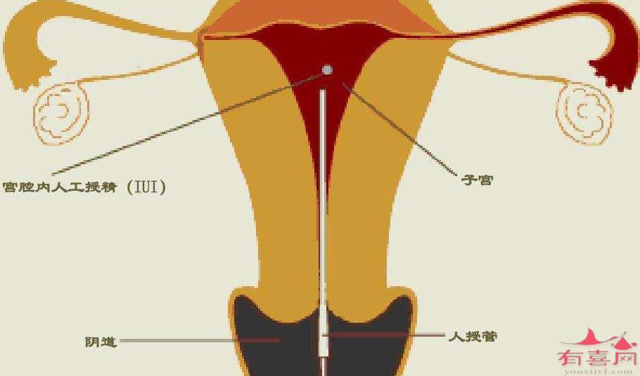 人工授精的成功率