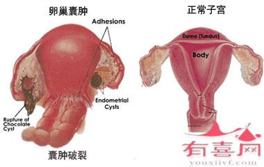 卵巢破裂的症状有哪些