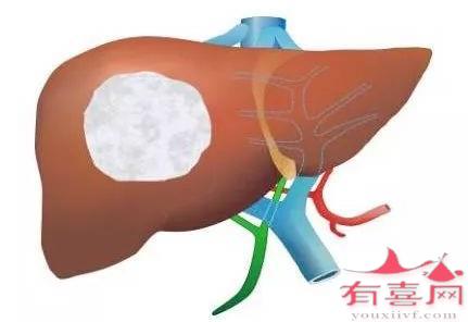 甲胎蛋白正常值是多少