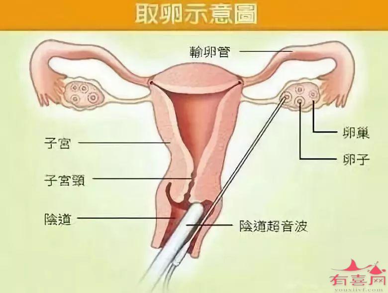 史上最全取卵过程