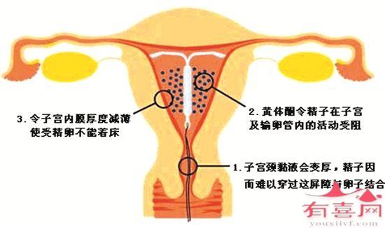 节育环的原理是什么