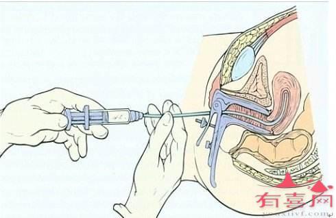 打促排卵针有什么副作用