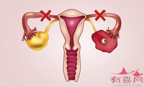 双侧输卵管切除又怀孕了可能吗