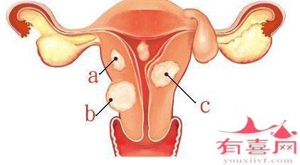 女性患了多囊卵巢可以自愈吗