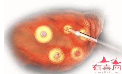 卵泡不破裂黄素化好治疗吗