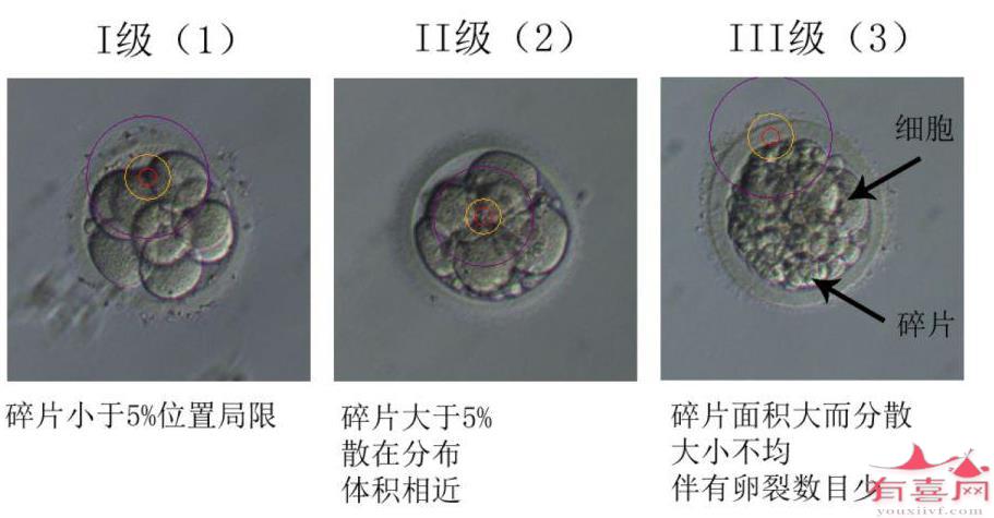 胚胎碎片多是精子问题还是卵子问题