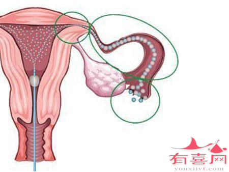 输卵管造影