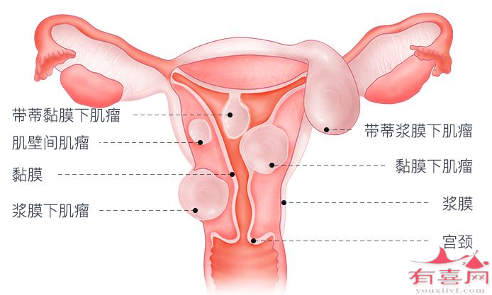 长了子宫肌瘤有什么症状